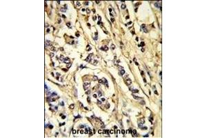 Formalin-fixed and paraffin-embedded human breast carcinoma reacted with VGFR2 Antibody, which was peroxidase-conjugated to the secondary antibody, followed by DAB staining. (VEGFR2/CD309 Antikörper)