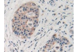 Detection of MMP19 in Human Pancreatic cancer Tissue using Polyclonal Antibody to Matrix Metalloproteinase 19 (MMP19) (MMP19 Antikörper  (AA 98-508))