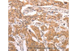 Immunohistochemistry of Human lung cancer using AASDHPPT Polyclonal Antibody at dilution of 1:30 (AASDHPPT Antikörper)