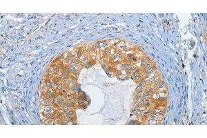 Immunohistochemistry of paraffin-embedded Human cervical cancer tissue using DGK zeta Polyclonal Antibody at dilution 1:60