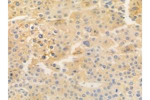 ABIN6258726 and ABIN6275560 at 1/100 staining human hepatocellular carcinoma by IHC-P.