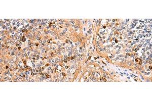 Immunohistochemistry of paraffin-embedded Human liver cancer tissue using KANSL1L Polyclonal Antibody at dilution of 1:40(x200) (KANSL1L Antikörper)
