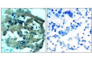 Immunohistochemical analysis of paraffin-embedded human lung carcinoma tissue, using Merlin (Ab-518) antibody (E021258). (Merlin Antikörper)