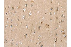 The image on the left is immunohistochemistry of paraffin-embedded Human brain tissue using ABIN7192520(SLC6A8 Antibody) at dilution 1/30, on the right is treated with synthetic peptide. (SLC6A8 Antikörper)