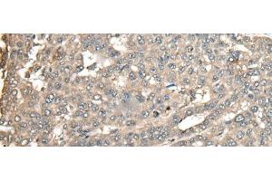 Immunohistochemistry of paraffin-embedded Human liver cancer tissue using ATXN3 Polyclonal Antibody at dilution of 1:100(x200) (Ataxin 3 Antikörper)