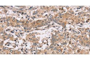 Immunohistochemistry of paraffin-embedded Human liver cancer using PPP1CC Polyclonal Antibody at dilution of 1:40 (PPP1CC Antikörper)