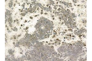 ABIN6263838 and ABIN6272757 at 1/100 staining human melanoma by IHC-P.