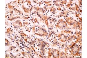 Formalin-fixed and paraffin embedded human gastric carcinoma labeled with Anti-CD99L2 Polyclonal Antibody, Unconjugated  at 1:200 followed by conjugation to the secondary antibody and DAB staining. (CD99L2 Antikörper  (AA 81-187))