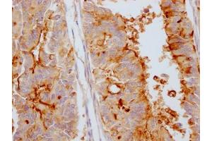 IHC image of ABIN7127379 diluted at 1:100 and staining in paraffin-embedded human endometrial cancer performed on a Leica BondTM system. (Rekombinanter MUC16 Antikörper)