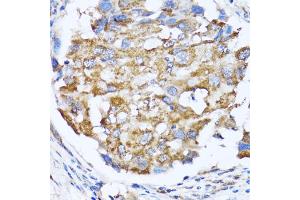 Immunohistochemistry of paraffin-embedded human breast cancer using NDE1 antibody (ABIN5974277) at dilution of 1/100 (40x lens). (NDE1 Antikörper)