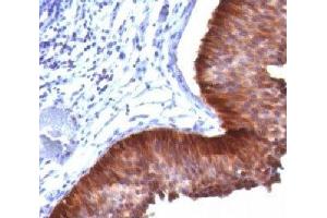 IHC testing of bladder carcinoma stained with Cytokeratin 17 antibody.