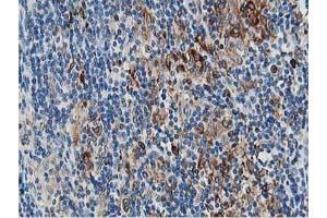 Immunohistochemical staining of paraffin-embedded Human lymphoma tissue using anti-PTPN1 mouse monoclonal antibody. (PTPN1 Antikörper)
