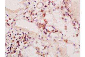 Formalin-fixed and paraffin embedded human colon carcinoma labeled with Anti-phospho-PIK3C3(Ser164)Polyclonal Antibody, Unconjugated  at 1:200 followed by conjugation to the secondary antibody and DAB staining (PIK3C3 Antikörper  (pSer164))