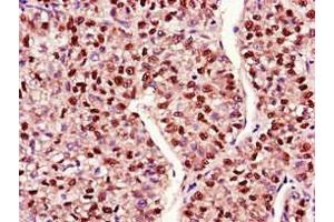 Immunohistochemistry of paraffin-embedded human liver cancer using ABIN7150711 at dilution of 1:100 (MAP2K4 Antikörper  (AA 259-398))