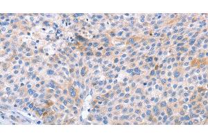 Immunohistochemistry of paraffin-embedded Human liver cancer using STK4 Polyclonal Antibody at dilution of 1:70 (STK4 Antikörper)