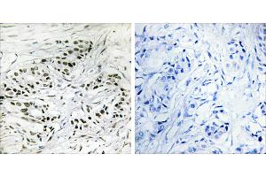 Peptide - +Immunohistochemistry analysis of paraffin-embedded human breast carcinoma tissue, using ERF antibody.