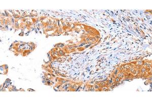 Immunohistochemistry of paraffin-embedded Human cervical cancer tissue using AP1B1 Polyclonal Antibody at dilution 1:70 (AP1B1 Antikörper)