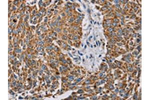 The image on the left is immunohistochemistry of paraffin-embedded Human lung cancer tissue using ABIN7130290(MTFP1 Antibody) at dilution 1/30, on the right is treated with fusion protein.