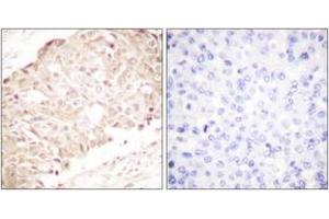Immunohistochemistry analysis of paraffin-embedded human breast carcinoma tissue, using SENP1 Antibody. (SENP1 Antikörper  (AA 1-50))