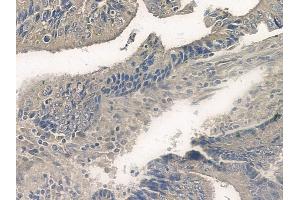 ABIN6255502 and ABIN6267099 at 1/100 staining human colon carcinoma by IHC-P. (BIM Antikörper  (pSer77))