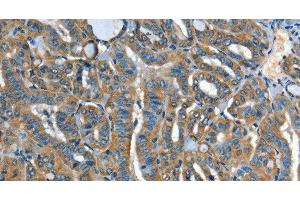 Immunohistochemistry of paraffin-embedded Human thyroid cancer tissue using ADCY4 Polyclonal Antibody at dilution 1:45