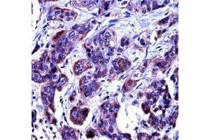 Caspase-6 antibody immunohistochemistry analysis in formalin fixed and paraffin embedded human bladder carcinoma. (Caspase 6 Antikörper  (AA 17-45))
