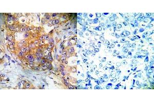Immunohistochemical analysis of paraffin- embedded human breast carcinoma tissue using 4E-BP1 (Ab-65) antibody (E022001). (eIF4EBP1 Antikörper)