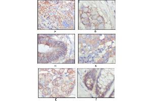Immunohistochemical analysis of paraffin-embedded human lung squamous cell carcinoma (A), lung adenocarcinoma (B), colon carcinoma (C), breast carcinoma (D), normal sublingual gland (E), normal rectal (F), showing membrane localization with DAB staining using EphB3 antibody. (EPH Receptor B3 Antikörper  (AA 39-212))