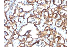 Formalin-fixed, paraffin-embedded human Angiosarcoma stained with CD34 Monoclonal Antibody (HPCA1/1171) (CD34 Antikörper)