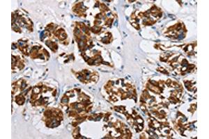 IHC analysis of paraffin-embedded human thyroid cancer tissue, using HINT2 antibody (1/50 dilution, 200X magnification). (HINT2 Antikörper)
