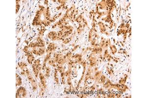 Immunohistochemistry of Human esophagus cancer using TAX1BP1 Polyclonal Antibody at dilution of 1:60 (TAX1BP1 Antikörper)