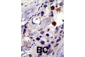 Formalin-fixed and paraffin-embedded human cancer tissue reacted with PSMD4 polyclonal antibody  , which was peroxidase-conjugated to the secondary antibody, followed by AEC staining. (PSMD4/ASF Antikörper  (AA 300-328))