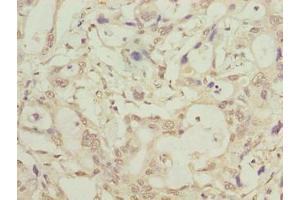 Immunohistochemistry of paraffin-embedded human pancreatic cancer using ABIN7158058 at dilution of 1:100 (LRTM1 Antikörper  (AA 1-212))