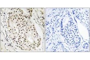 Immunohistochemistry analysis of paraffin-embedded human breast carcinoma tissue, using HNRNPUL2 Antibody. (HNRNPUL2 Antikörper  (AA 601-650))