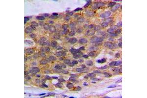 Immunohistochemical analysis of PLA2G4A staining in human breast cancer formalin fixed paraffin embedded tissue section. (PLA2G4A Antikörper  (Center))