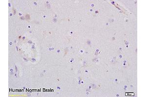 Formalin-fixed and paraffin embedded human glioma tissue labeled with Anti-PCNA Polyclonal Antibody, Unconjugated (ABIN676583) at 1:200 followed by conjugation to the secondary antibody and DAB staining