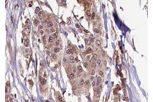 ABIN6272333 at 1/100 staining Human breast cancer tissue by IHC-P.