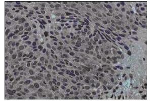 Immunohistochemical staining of human cervical cancer tissue (40X magnification) using  Protein A purified anti-Jagged-1 antibody. (JAG1 Antikörper  (Internal Region))