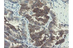 Immunohistochemical staining of paraffin-embedded Adenocarcinoma of Human ovary tissue using anti-DOK7 mouse monoclonal antibody. (DOK7 Antikörper)