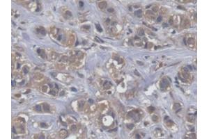 DAB staining on IHC-P; Samples: Human Breast cancer Tissue (EEF2 Antikörper  (AA 32-233))