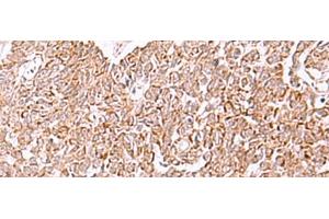 Immunohistochemistry of paraffin-embedded Human ovarian cancer tissue using IRX2 Polyclonal Antibody at dilution of 1:45(x200) (IRX2 Antikörper)