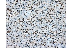 Immunohistochemical staining of paraffin-embedded Adenocarcinoma of colon tissue using anti-CYP1A2 mouse monoclonal antibody. (CYP1A2 Antikörper)