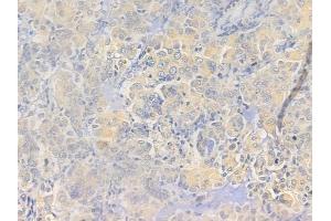 ABIN6257755 and ABIN6273649 at 1/100 staining human lung adenocarcinoma by IHC-P. (IL12B Antikörper  (C-Term))