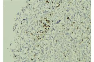 ABIN6272880 at 1/100 staining Human breast cancer tissue by IHC-P. (SGTA Antikörper  (C-Term))
