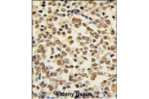 Formalin-fixed and paraffin-embedded human kideny carcinoma tissue reacted with ERK5 Antibody (C-term) (ABIN391722 and ABIN2841612) , which was peroxidase-conjugated to the secondary antibody, followed by DAB staining. (MAPK7 Antikörper  (C-Term))