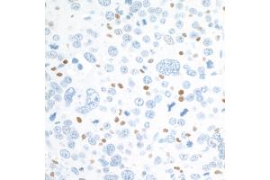 Immunohistochemistry (IHC) image for anti-V-Maf Musculoaponeurotic Fibrosarcoma Oncogene Homolog (Avian) (MAF) (AA 125-175) antibody (ABIN7455089) (Rekombinanter MAF Antikörper  (AA 125-175))