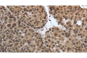 Immunohistochemistry of paraffin-embedded Human liver cancer tissue using SMAD7 Polyclonal Antibody at dilution 1:40 (SMAD7 Antikörper)