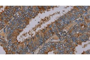 Immunohistochemistry of paraffin-embedded Human colon cancer tissue using PYY Polyclonal Antibody at dilution 1:30 (Peptide YY Antikörper)