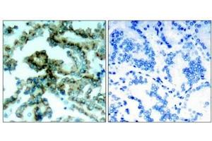 Immunohistochemical analysis of paraffin-embedded human lung carcinoma tissue, using PKCb(phospho-Thr641) antibody.