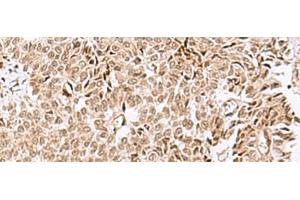 Immunohistochemistry of paraffin-embedded Human ovarian cancer tissue using ELAC1 Polyclonal Antibody at dilution of 1:50(x200) (ELAC1 Antikörper)